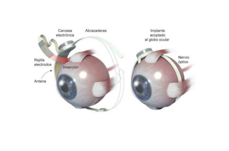 Ojos biónicos contra la ceguera